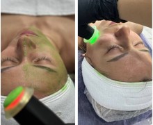 Идеальная кожа — без уколов