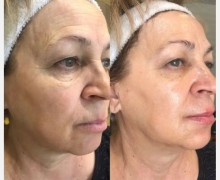 Идеальная кожа — без уколов