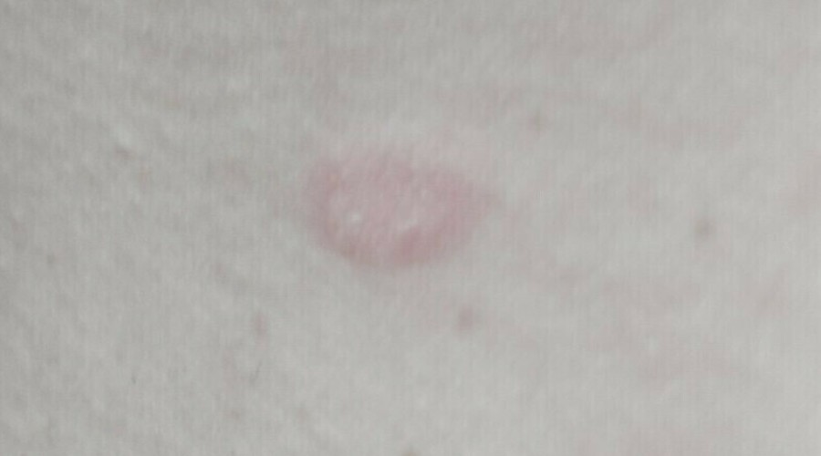 В мире признаки новой эпидемии: по Европе стремительно распространяется опасный генитальный супергрибок